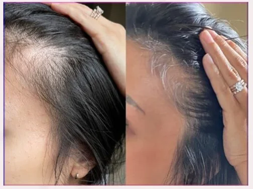 before-after-aoi-2